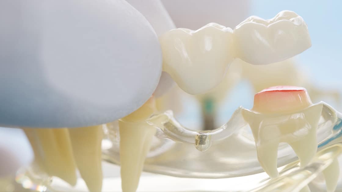 Dental Bridge Decorative Image