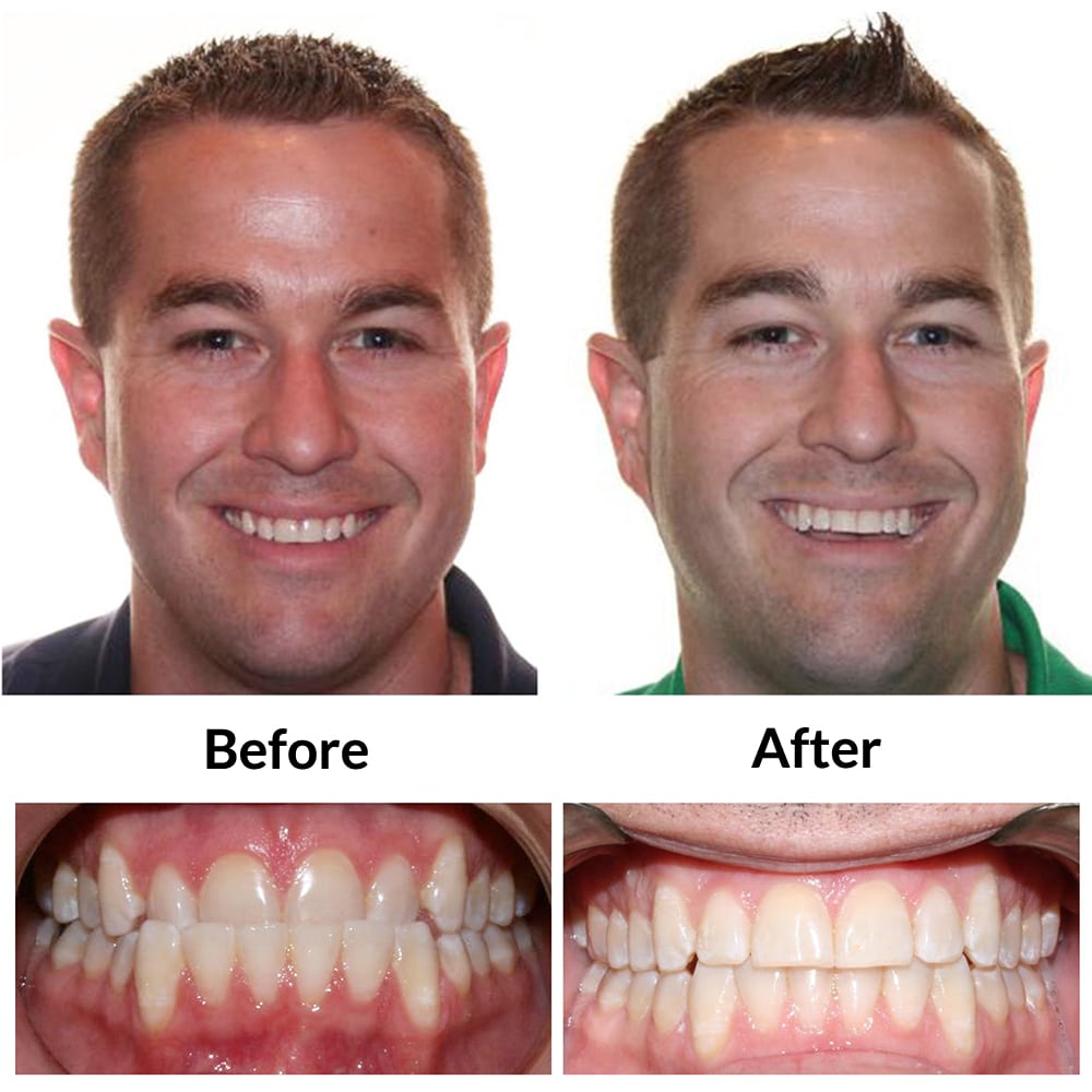 Invisalign Before and After Image