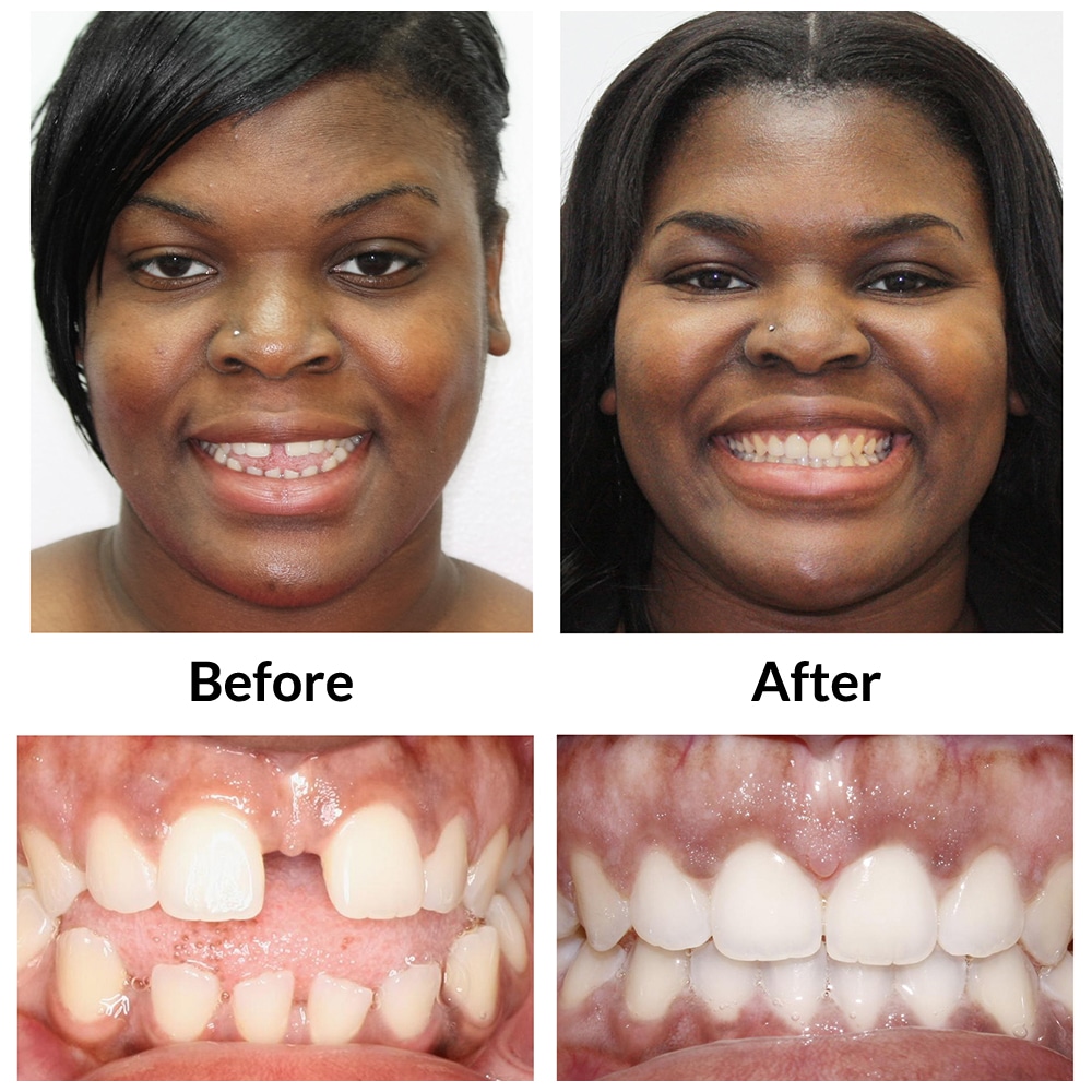 Invisalign Before and After Image