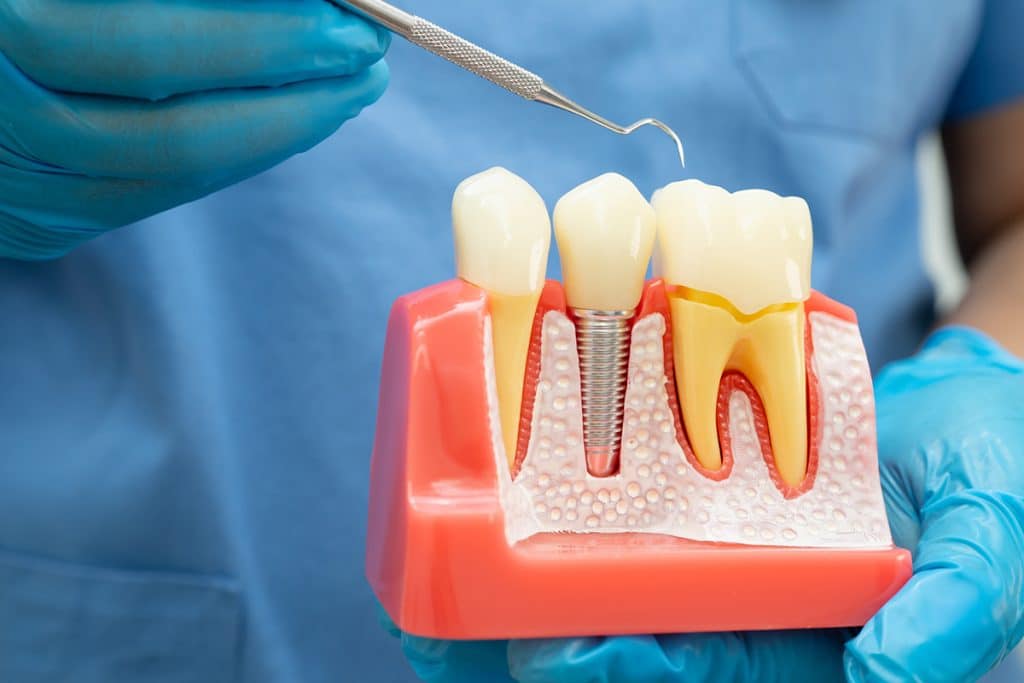 Benefits of Choosing Dental Implants Over Traditional Dentures