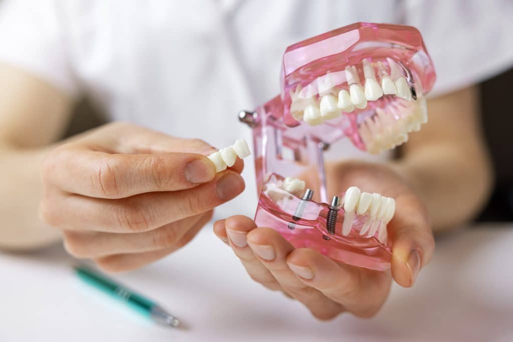 How to Choose Between Dental Bridges and Implants for Missing Teeth