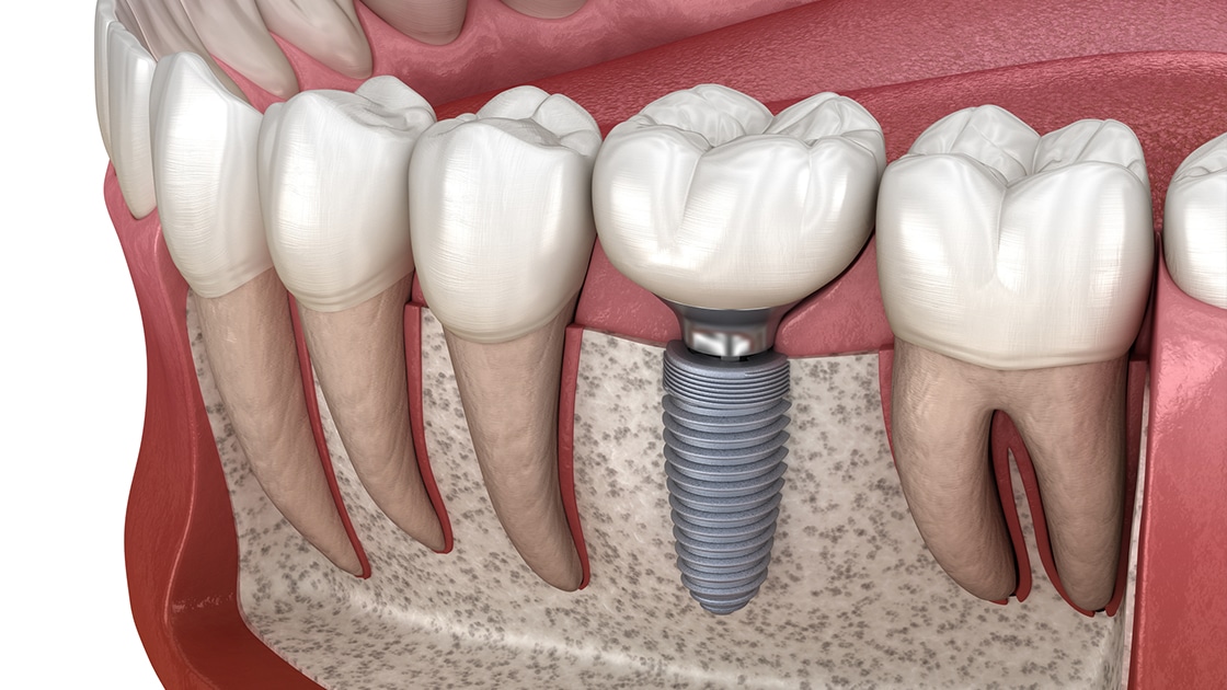 Dental Implant Illustration