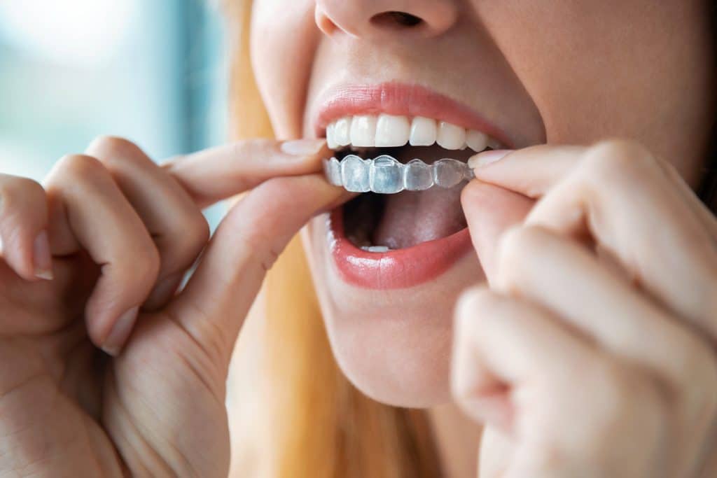 Invisalign vs. Traditional Braces: Which Is Right for You?