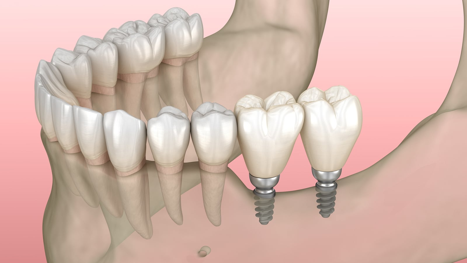 Mini Dental Implant Image